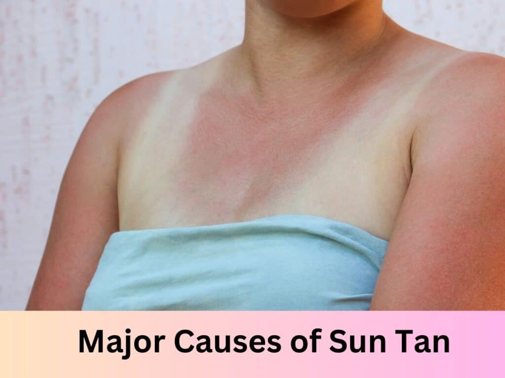 Major Causes of Sun Tan